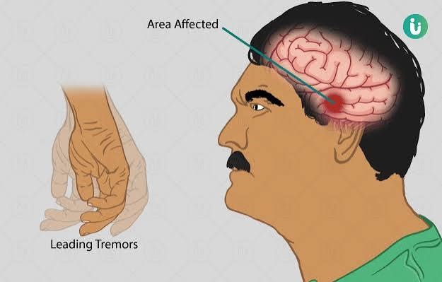 Parkinsonism - நடுக்குவாதம்