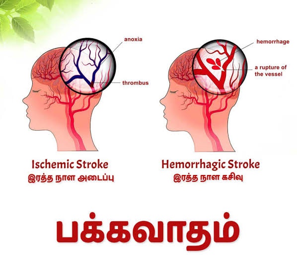 பக்கவாதம் (Stroke)